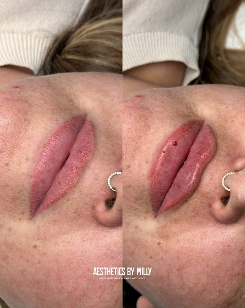 Lip filler, before and after