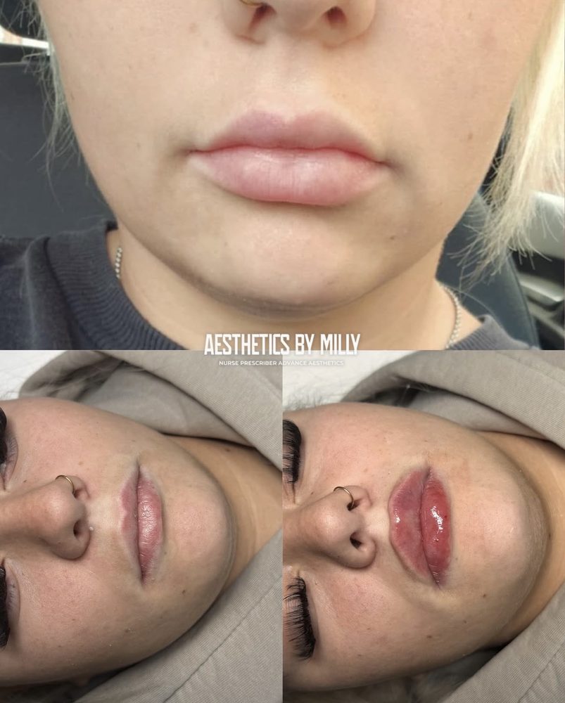 Lip filler, before and after