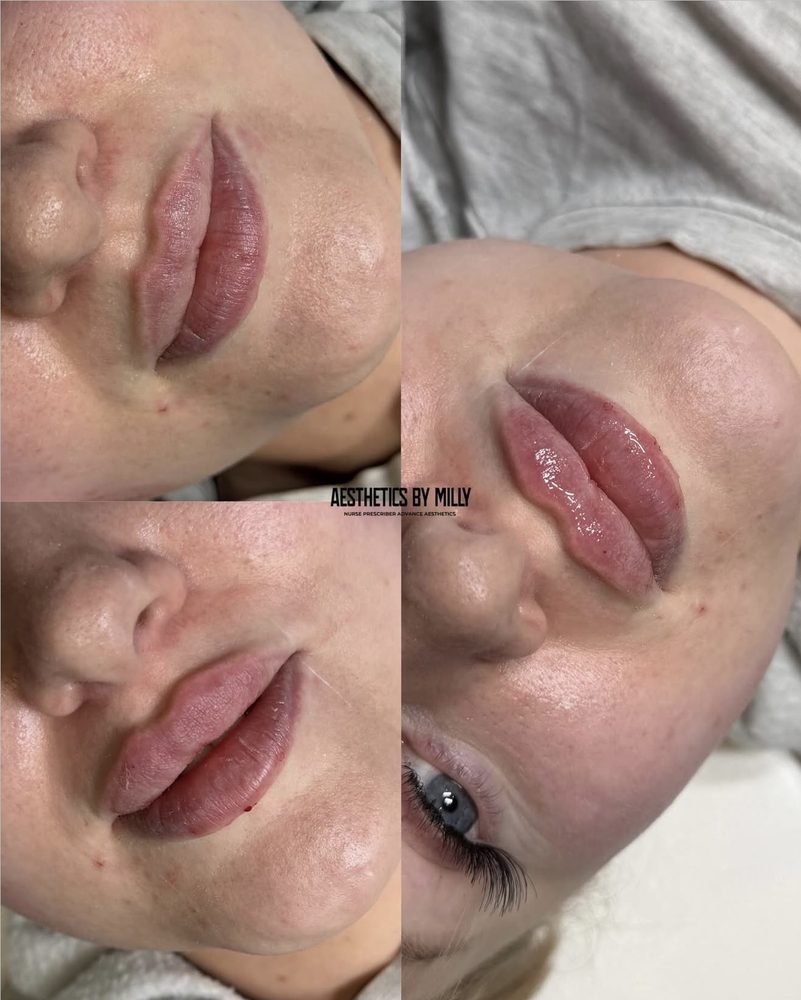 Lip filler, before and after