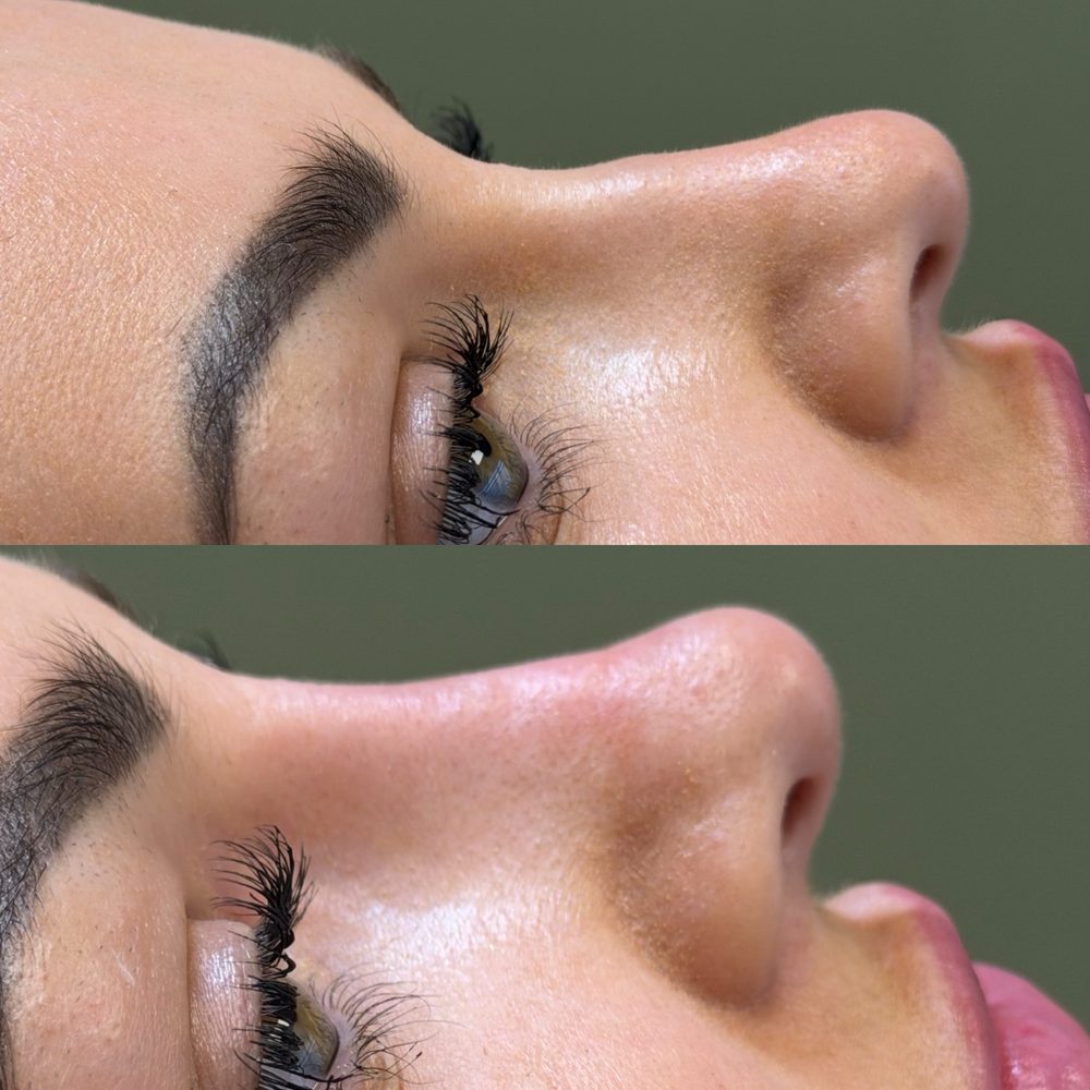 Non-surgical rhinoplasty, before and after